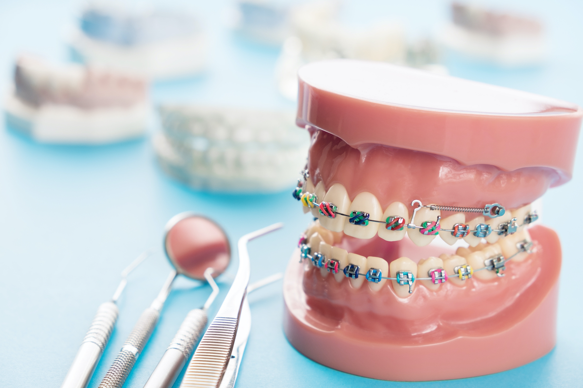 Model of teeth with different colored dental braces next to variety of dental tools