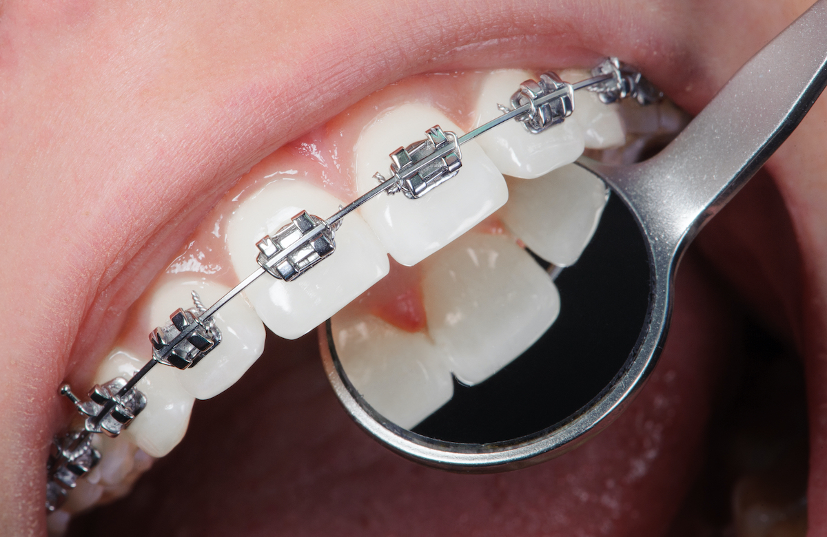 Using OrthoPhoto For Dental Braces Treatment