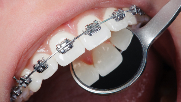 close-up image of teeth with dental braces