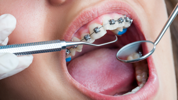 dental braces patient visiting the orthodontist