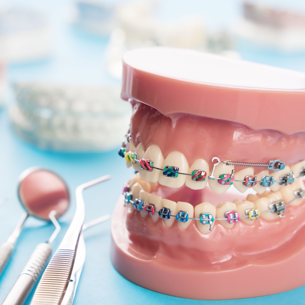A mold of teeth with braces