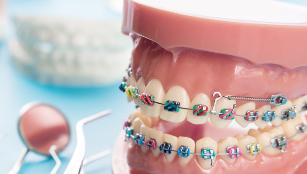 A mold of teeth with braces
