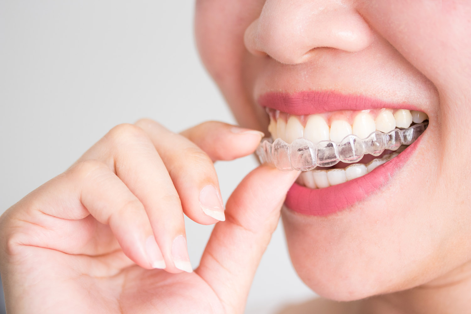 patient holding clear aligners